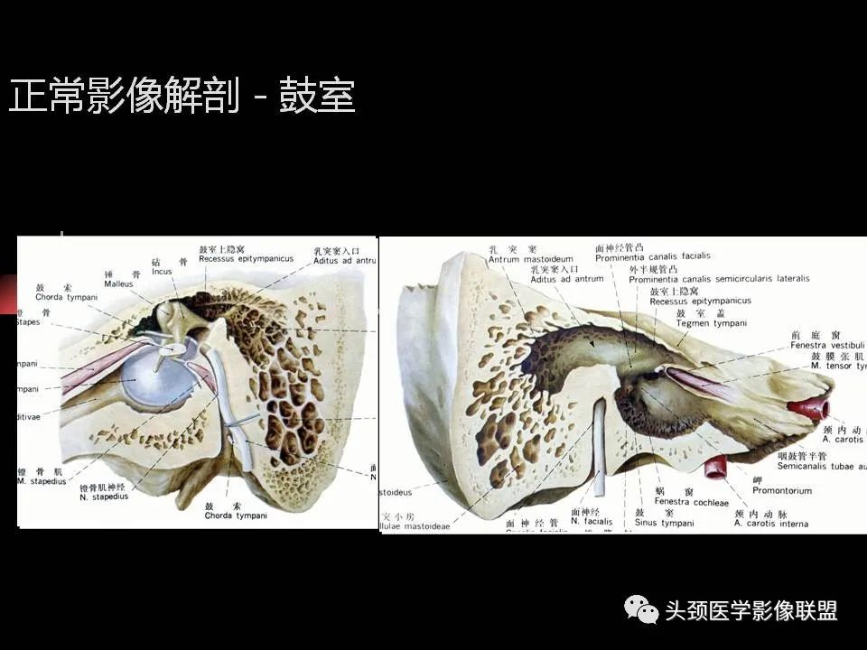 影像PPT - 【PPT】中耳乳突解剖及常见疾病-10