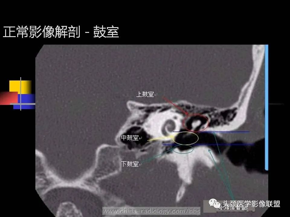 影像PPT - 【PPT】中耳乳突解剖及常见疾病-11