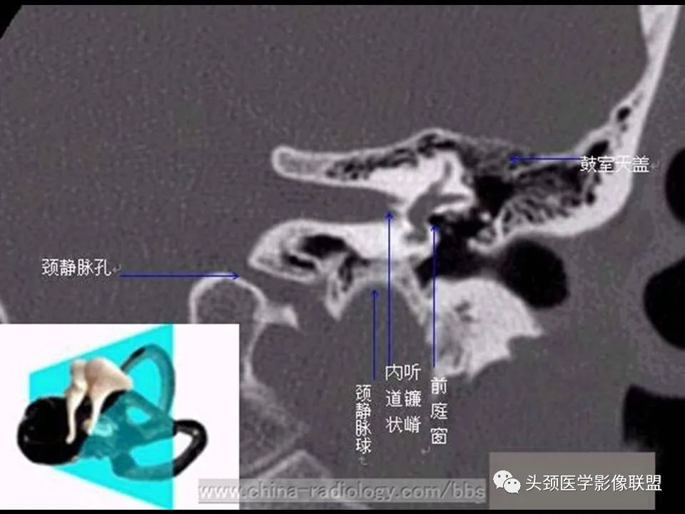 影像PPT - 【PPT】中耳乳突解剖及常见疾病-15