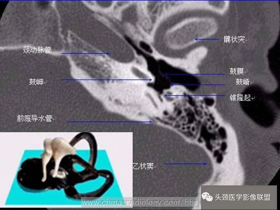 影像PPT - 【PPT】中耳乳突解剖及常见疾病-13