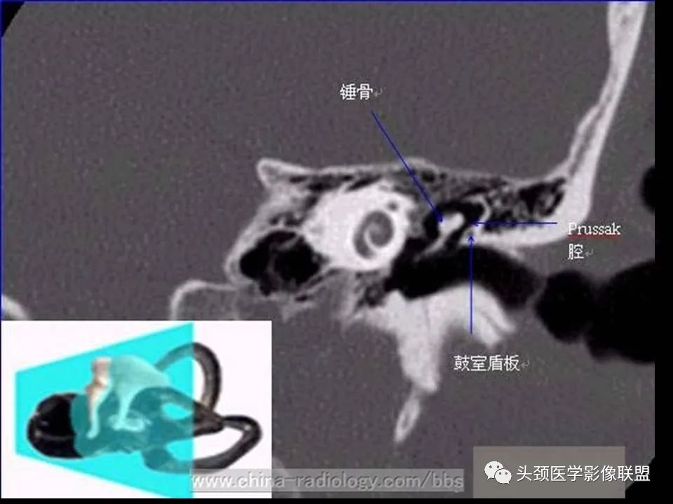 影像PPT - 【PPT】中耳乳突解剖及常见疾病-16