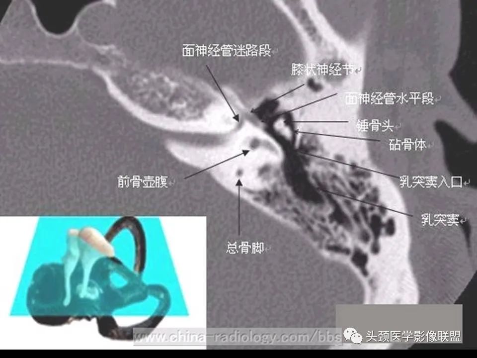 影像PPT - 【PPT】中耳乳突解剖及常见疾病-20