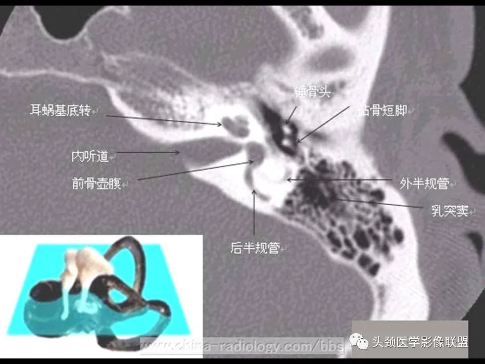 影像PPT - 【PPT】中耳乳突解剖及常见疾病-21