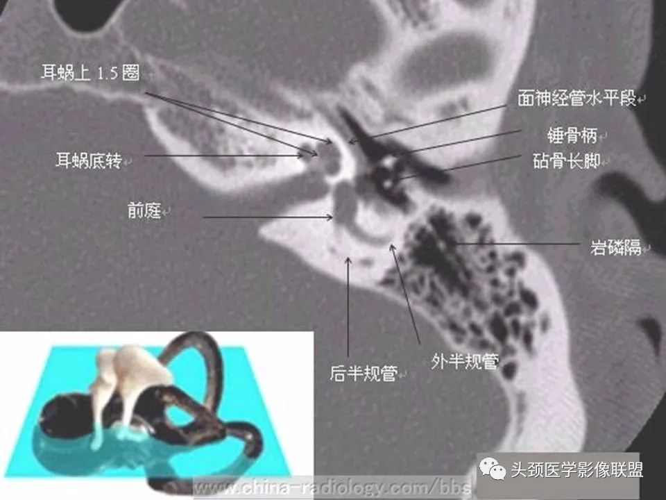 影像PPT - 【PPT】中耳乳突解剖及常见疾病-22