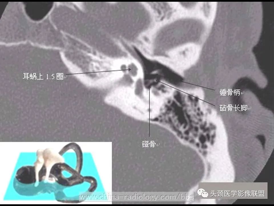 影像PPT - 【PPT】中耳乳突解剖及常见疾病-23