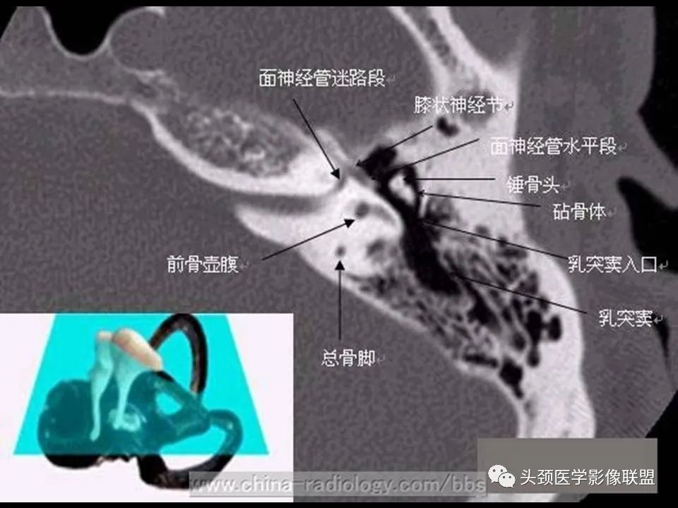 影像PPT - 【PPT】中耳乳突解剖及常见疾病-25