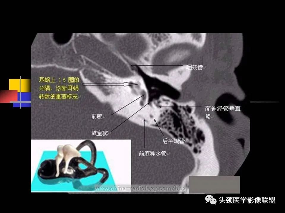 影像PPT - 【PPT】中耳乳突解剖及常见疾病-31