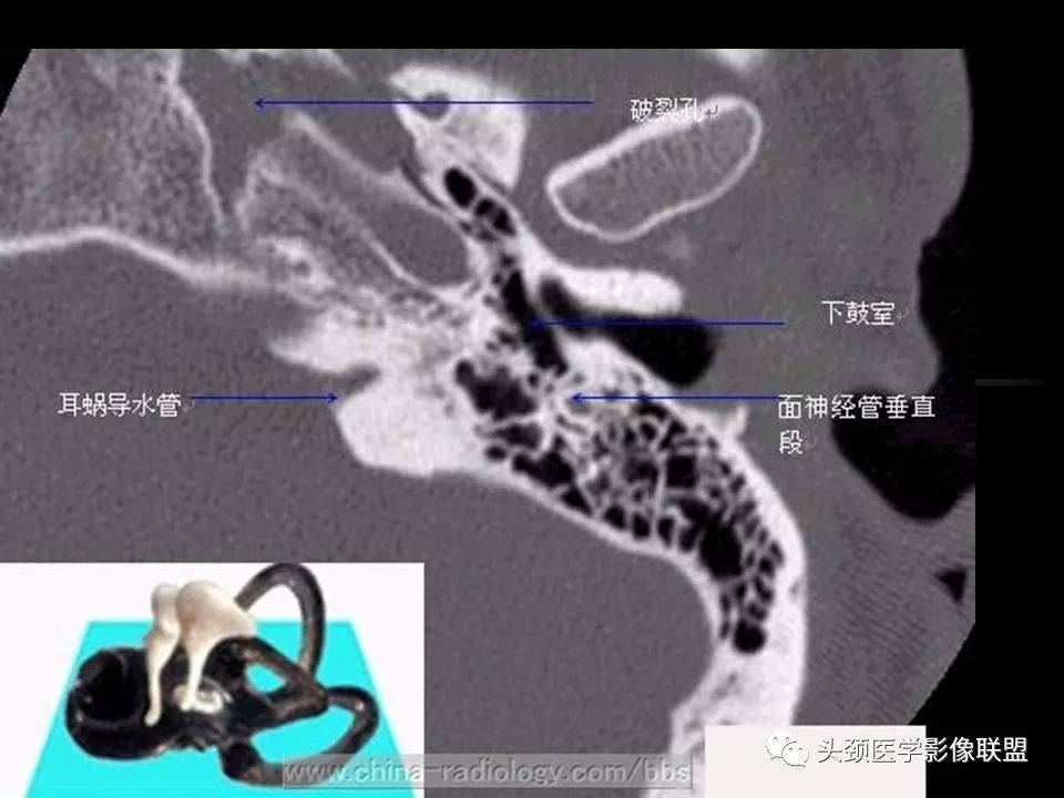 影像PPT - 【PPT】中耳乳突解剖及常见疾病-33