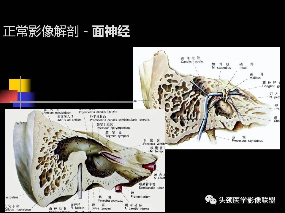 影像PPT - 【PPT】中耳乳突解剖及常见疾病-36