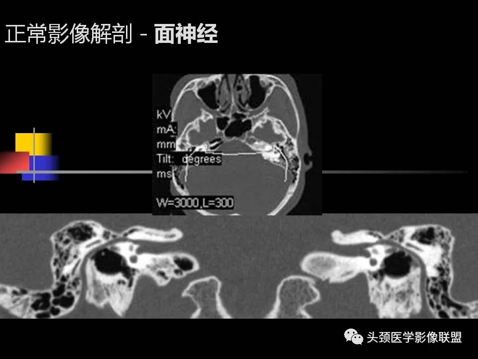 影像PPT - 【PPT】中耳乳突解剖及常见疾病-37