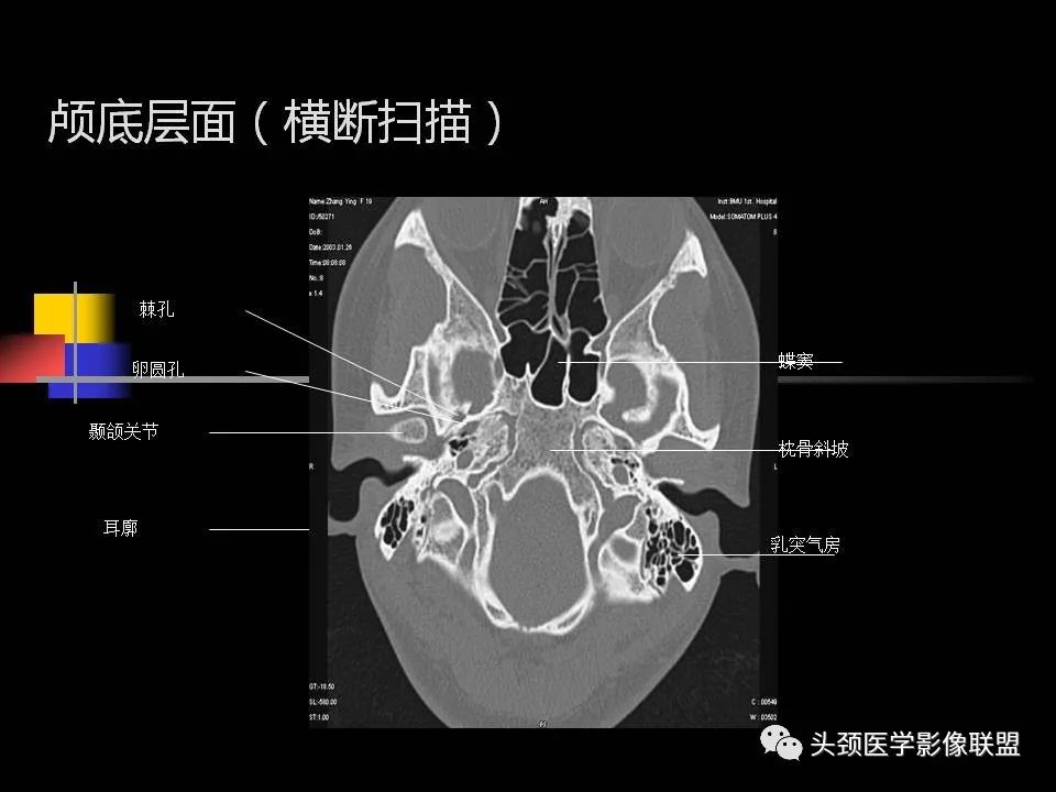 影像PPT - 【PPT】中耳乳突解剖及常见疾病-38