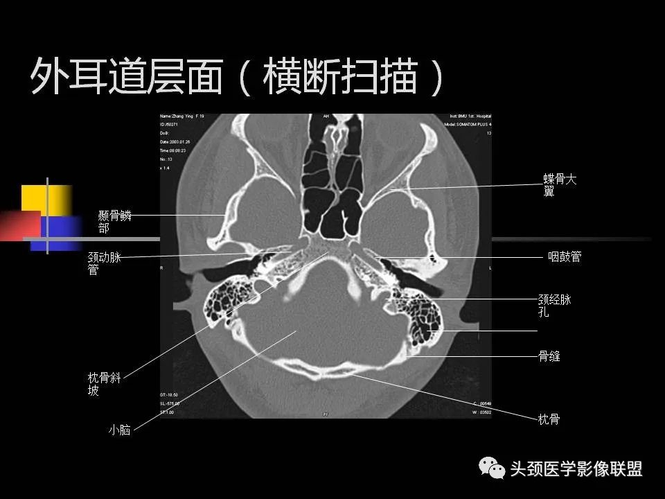 影像PPT - 【PPT】中耳乳突解剖及常见疾病-39