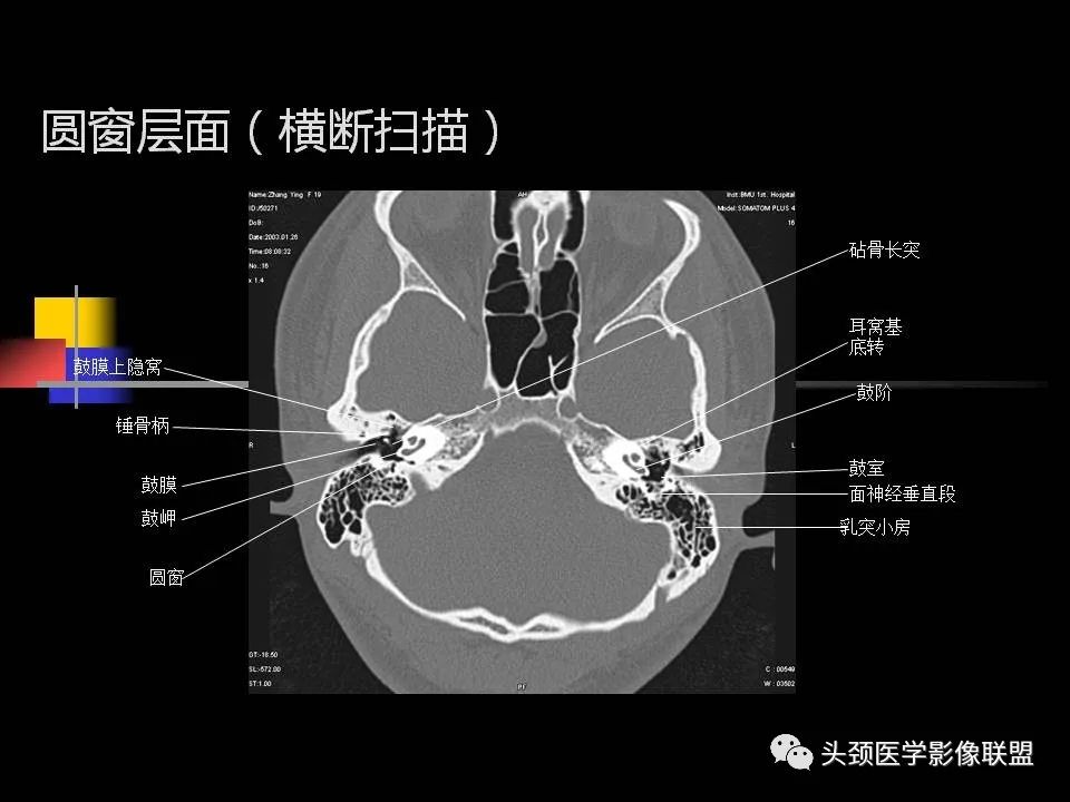影像PPT - 【PPT】中耳乳突解剖及常见疾病-40