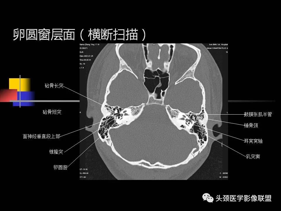 影像PPT - 【PPT】中耳乳突解剖及常见疾病-41