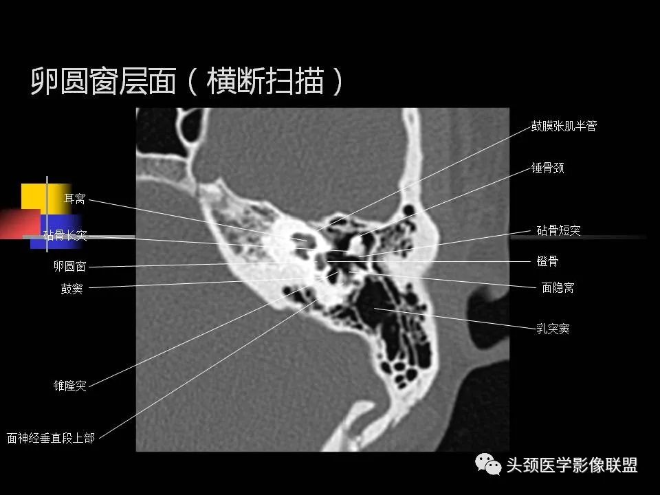 影像PPT - 【PPT】中耳乳突解剖及常见疾病-42