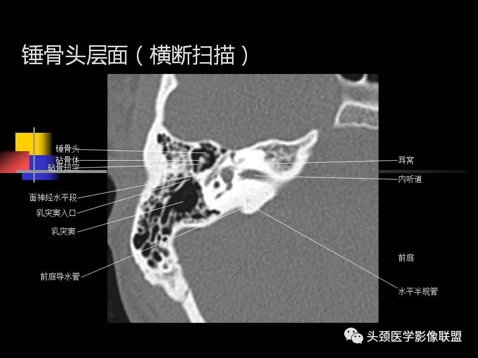 影像PPT - 【PPT】中耳乳突解剖及常见疾病-43