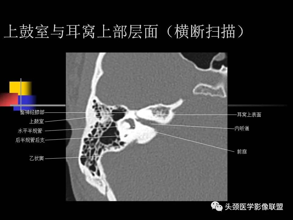 影像PPT - 【PPT】中耳乳突解剖及常见疾病-44