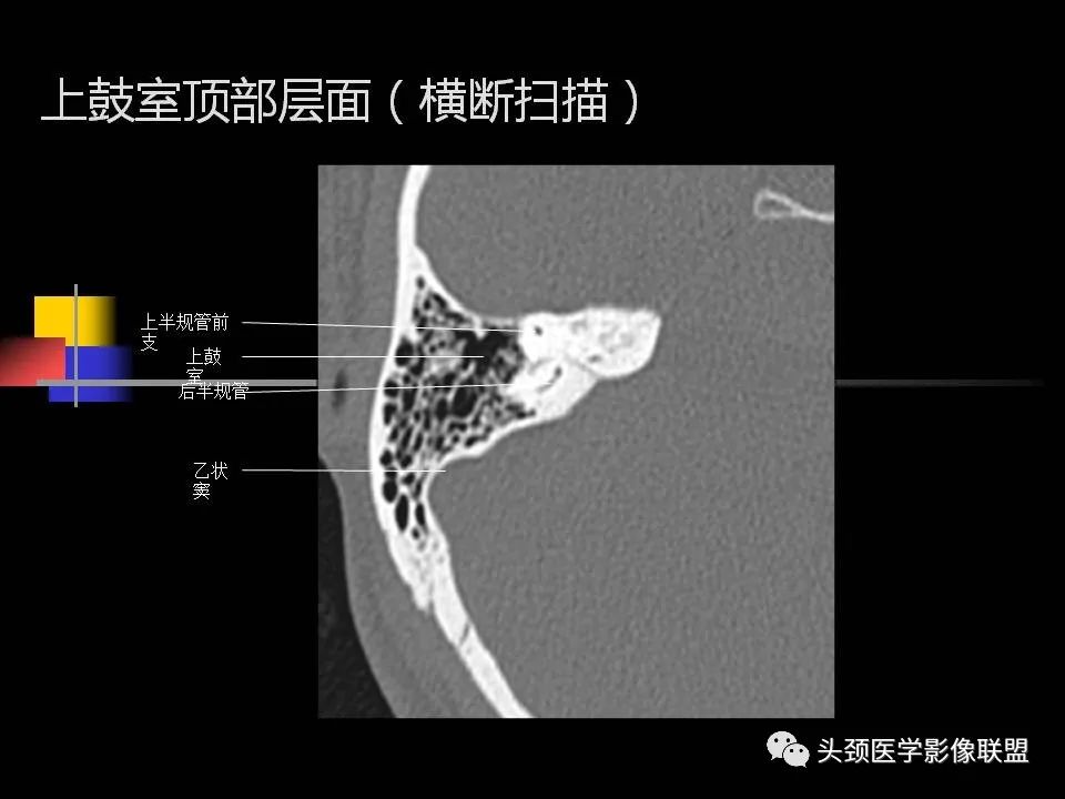 影像PPT - 【PPT】中耳乳突解剖及常见疾病-45