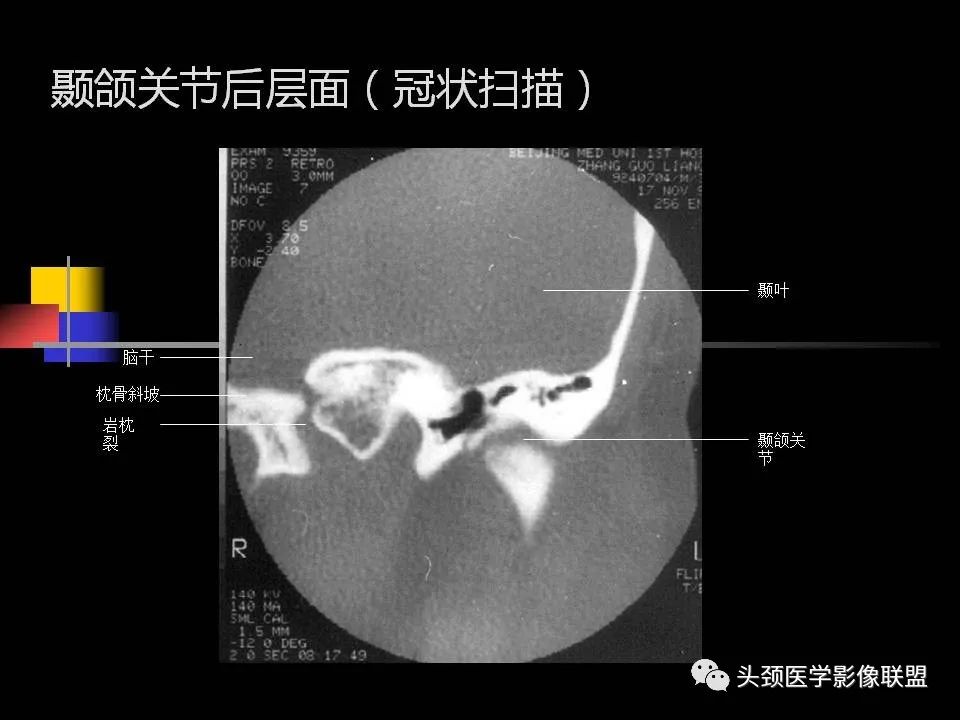 影像PPT - 【PPT】中耳乳突解剖及常见疾病-46