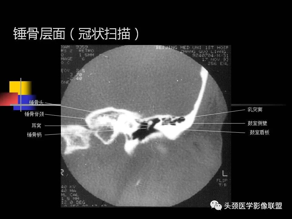 影像PPT - 【PPT】中耳乳突解剖及常见疾病-47