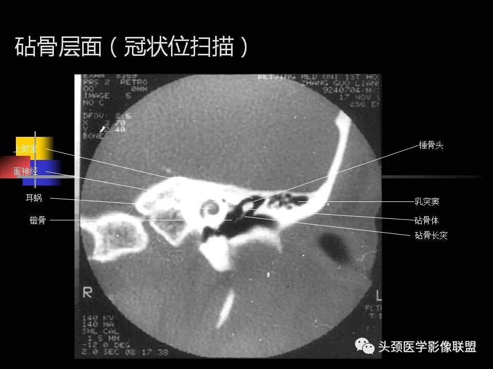 影像PPT - 【PPT】中耳乳突解剖及常见疾病-48