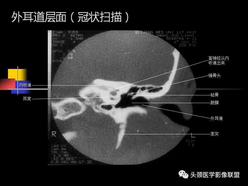 影像PPT - 【PPT】中耳乳突解剖及常见疾病-49
