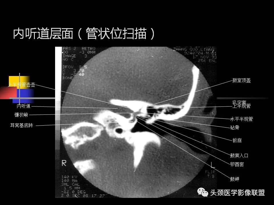 影像PPT - 【PPT】中耳乳突解剖及常见疾病-50