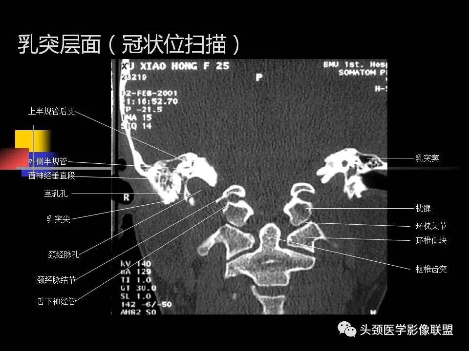 影像PPT - 【PPT】中耳乳突解剖及常见疾病-51