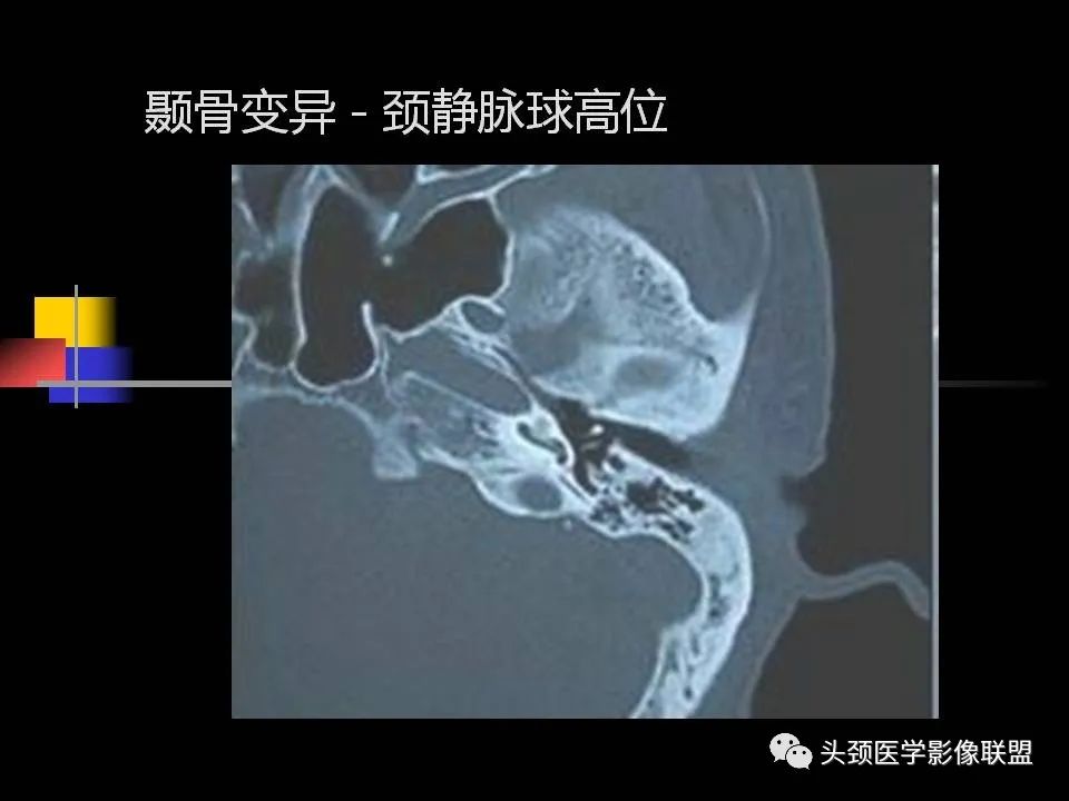 影像PPT - 【PPT】中耳乳突解剖及常见疾病-53