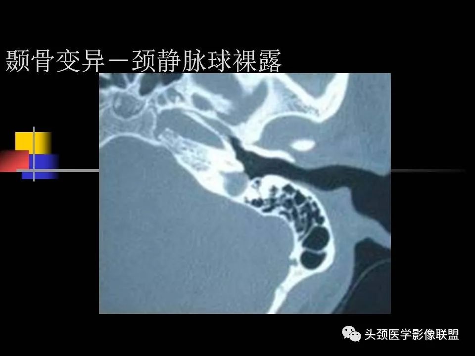 影像PPT - 【PPT】中耳乳突解剖及常见疾病-55