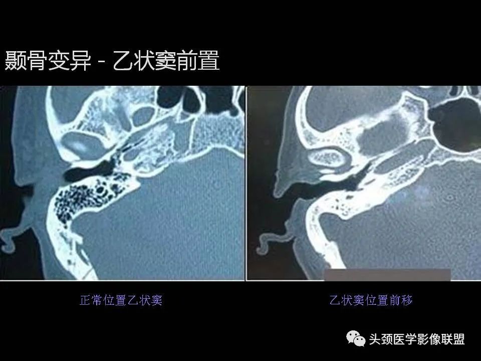 影像PPT - 【PPT】中耳乳突解剖及常见疾病-57