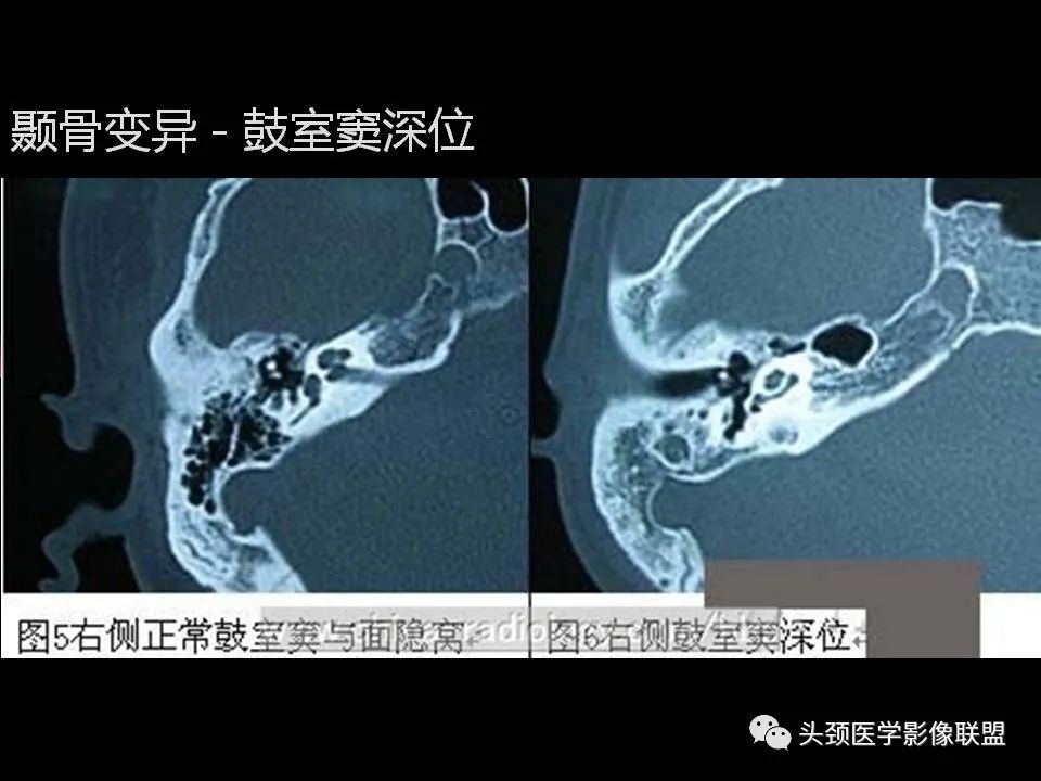 影像PPT - 【PPT】中耳乳突解剖及常见疾病-59