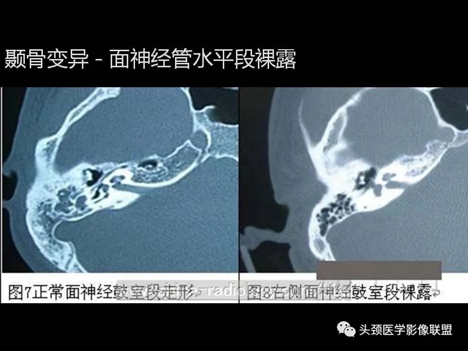 影像PPT - 【PPT】中耳乳突解剖及常见疾病-61