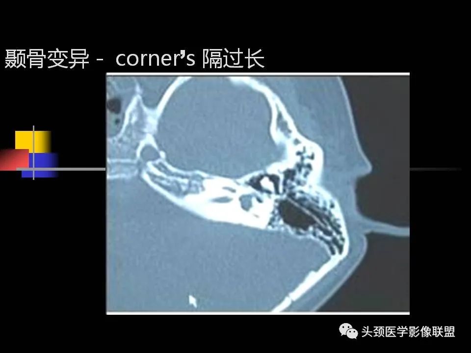 影像PPT - 【PPT】中耳乳突解剖及常见疾病-63