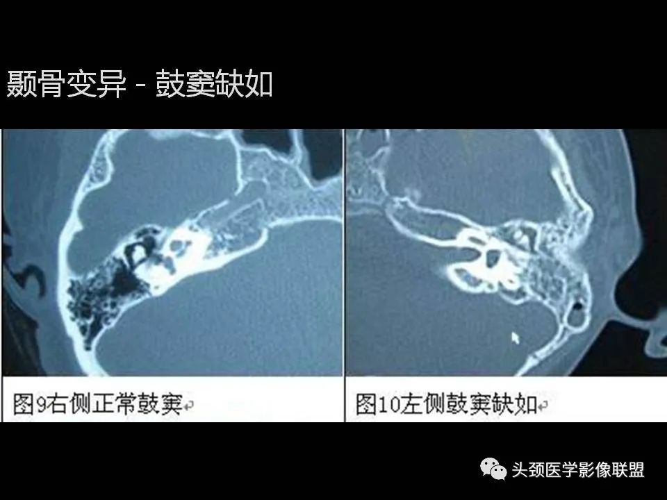 影像PPT - 【PPT】中耳乳突解剖及常见疾病-65