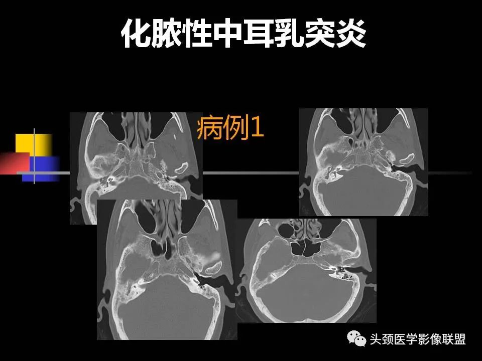 影像PPT - 【PPT】中耳乳突解剖及常见疾病-70