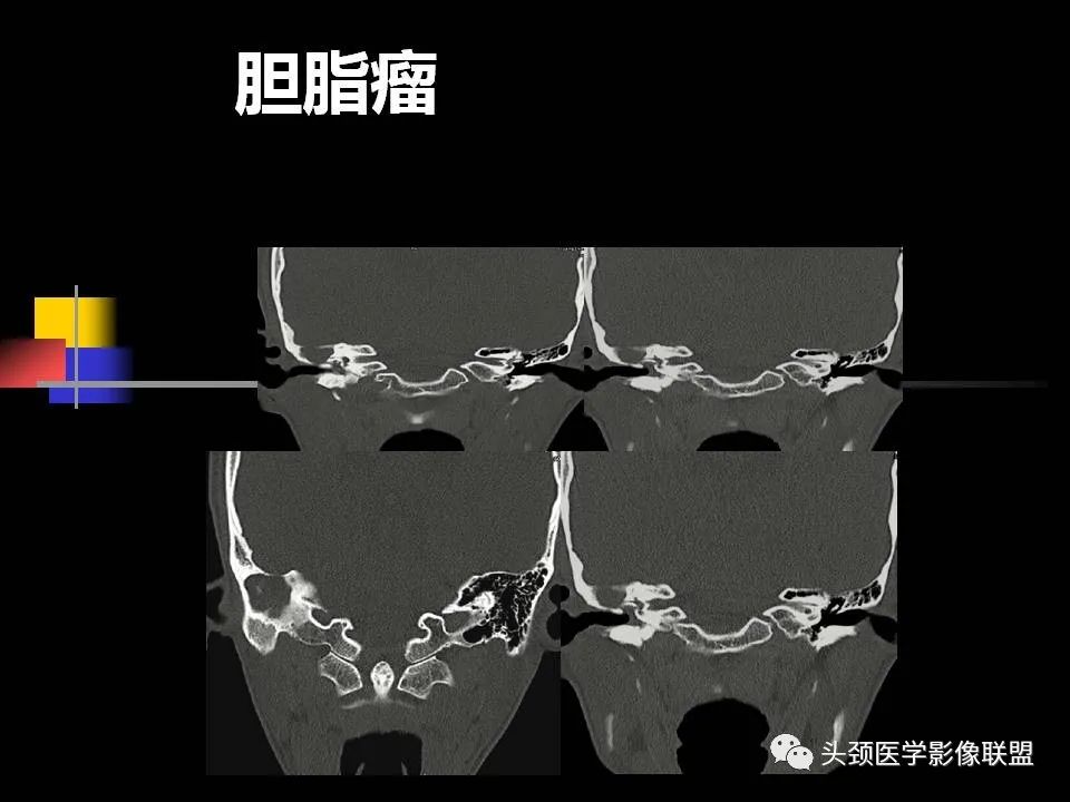 影像PPT - 【PPT】中耳乳突解剖及常见疾病-75