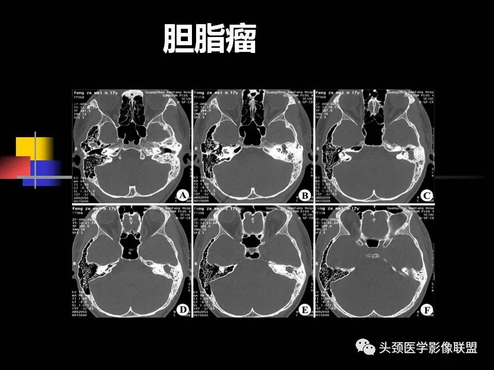 影像PPT - 【PPT】中耳乳突解剖及常见疾病-76