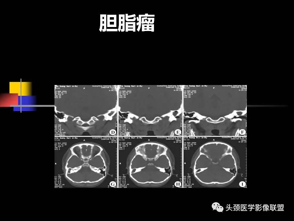影像PPT - 【PPT】中耳乳突解剖及常见疾病-77