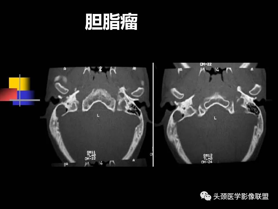 影像PPT - 【PPT】中耳乳突解剖及常见疾病-78