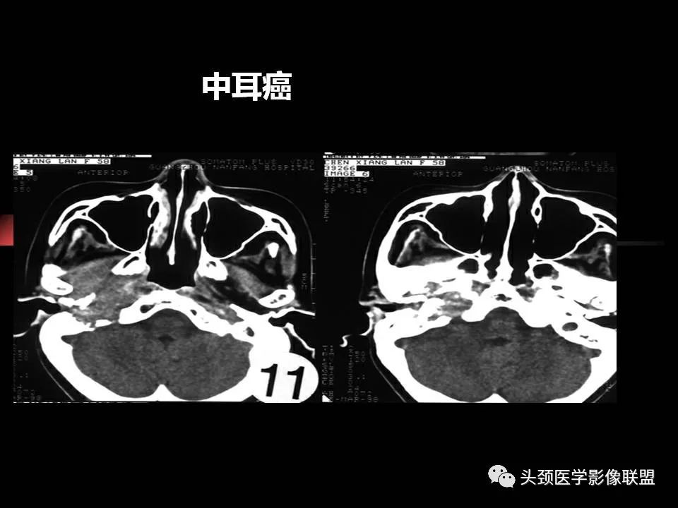 影像PPT - 【PPT】中耳乳突解剖及常见疾病-81