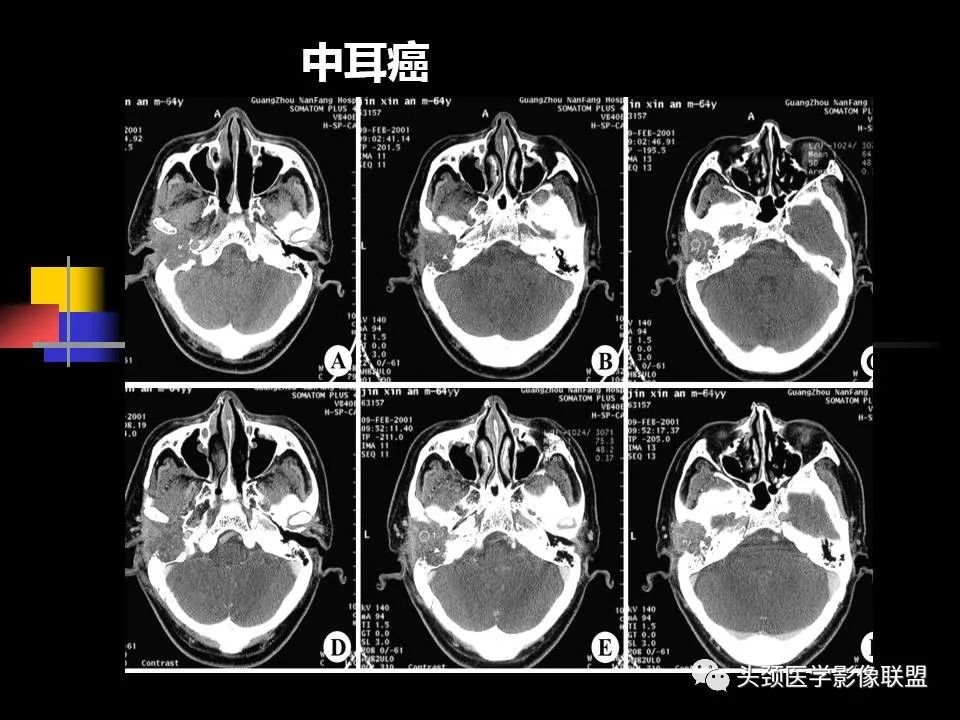 影像PPT - 【PPT】中耳乳突解剖及常见疾病-82