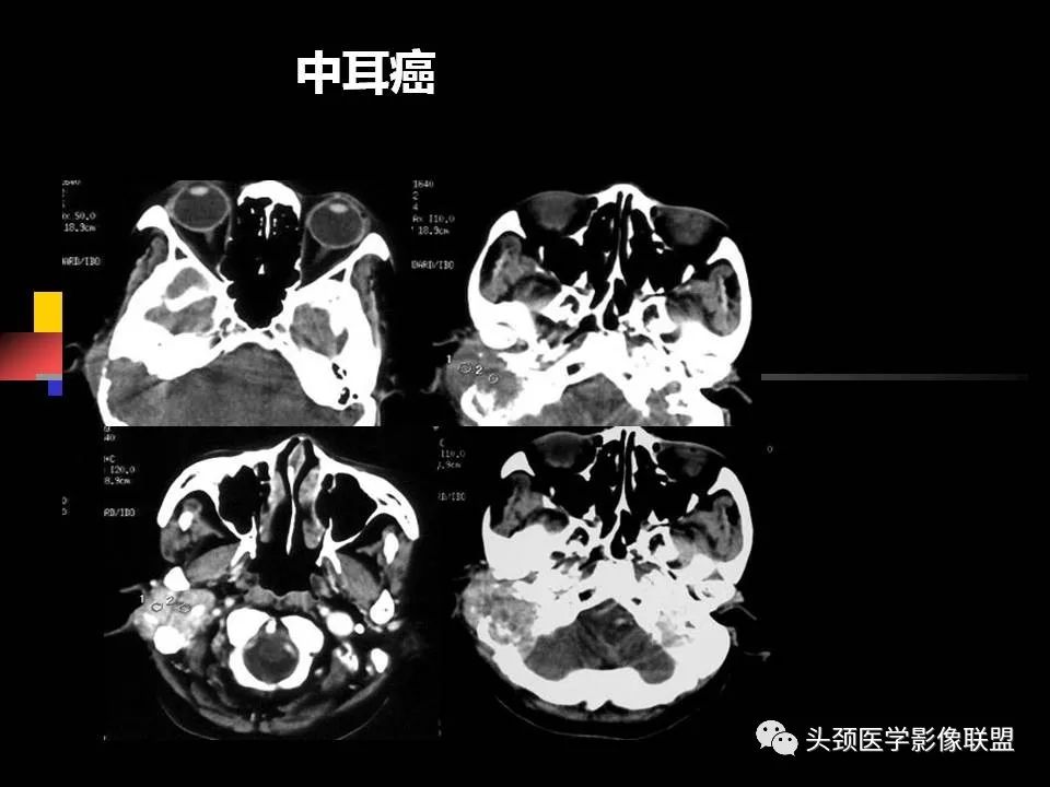 影像PPT - 【PPT】中耳乳突解剖及常见疾病-83