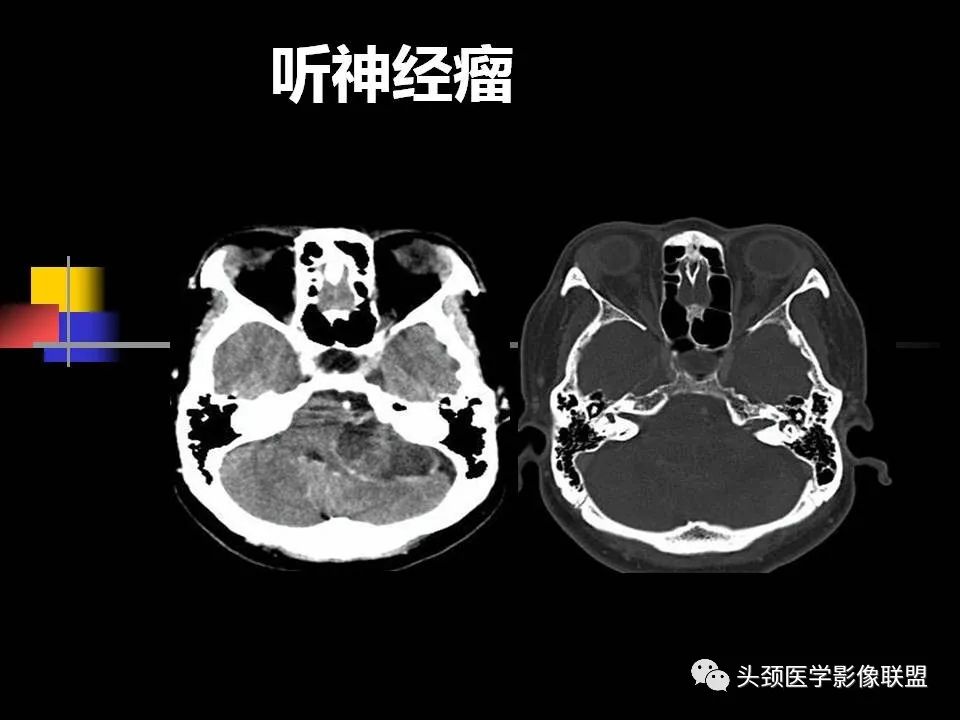 影像PPT - 【PPT】中耳乳突解剖及常见疾病-85
