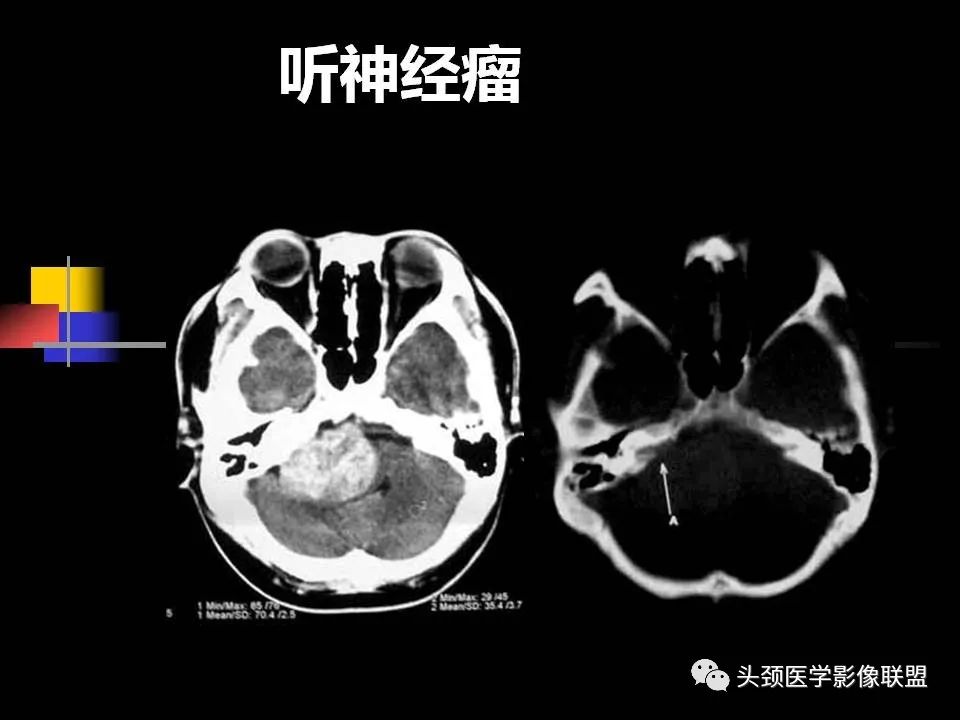 影像PPT - 【PPT】中耳乳突解剖及常见疾病-86