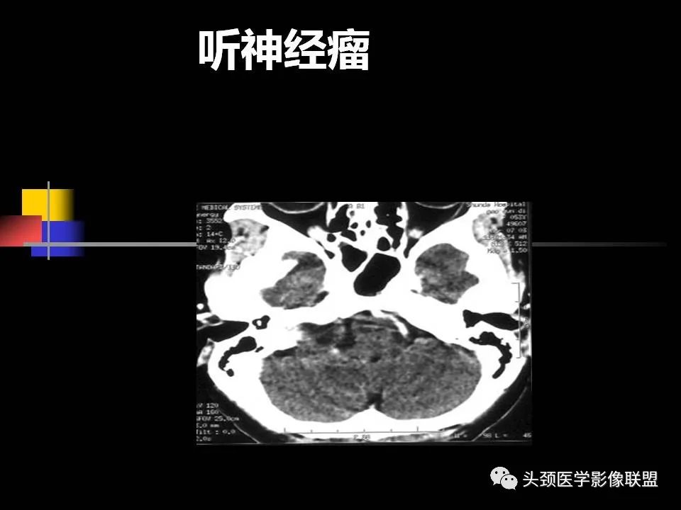 影像PPT - 【PPT】中耳乳突解剖及常见疾病-87