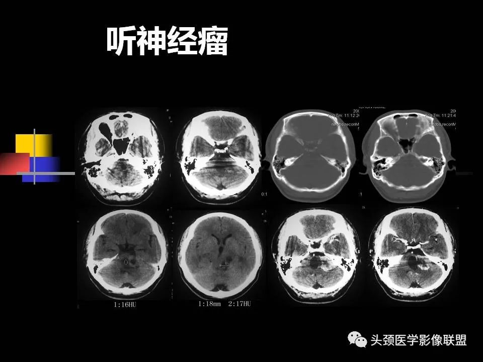 影像PPT - 【PPT】中耳乳突解剖及常见疾病-88