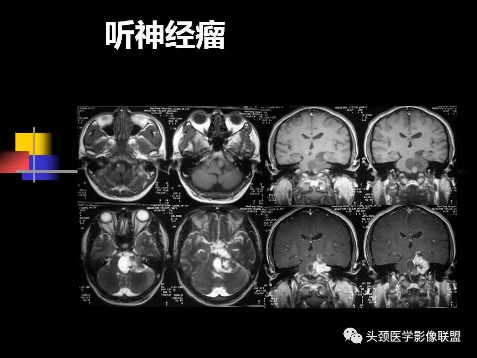 影像PPT - 【PPT】中耳乳突解剖及常见疾病-89