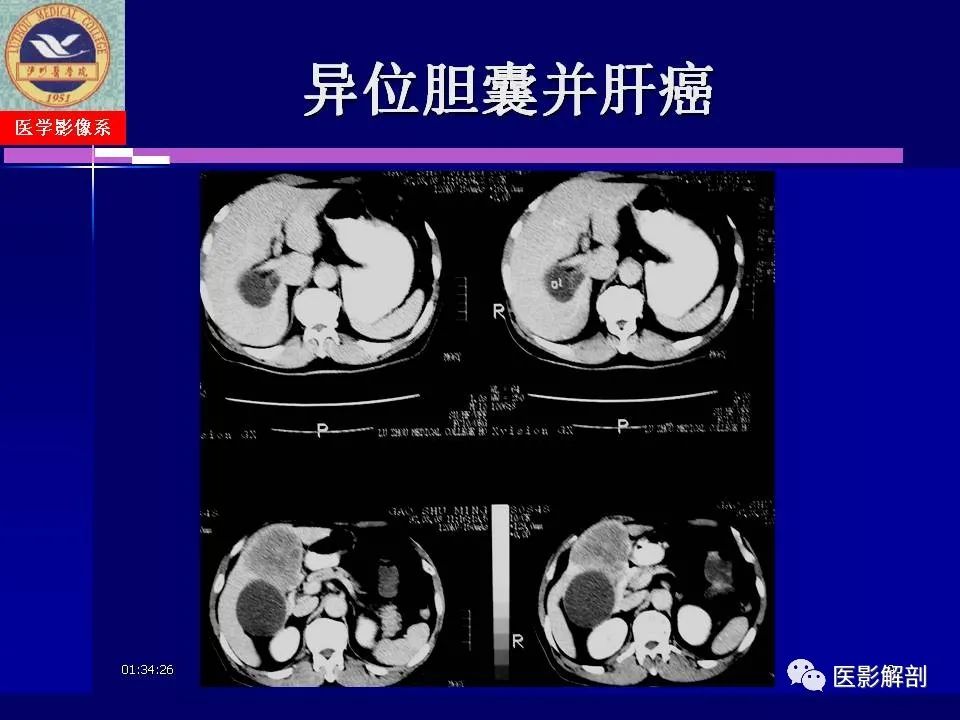 影像PPT - 【PPT】胆道系统病变的CT诊断-9