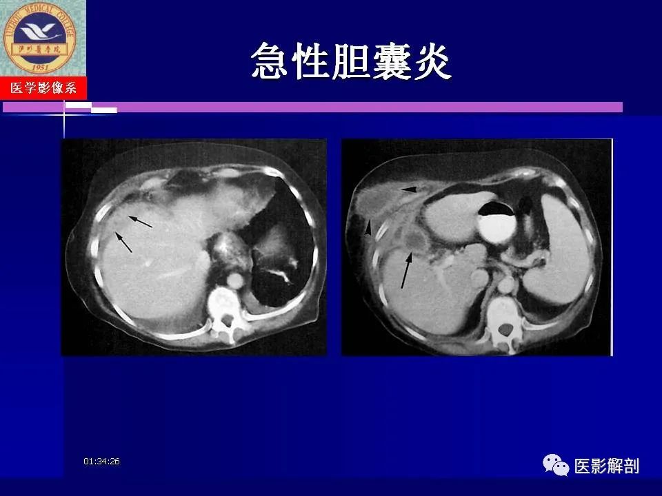 影像PPT - 【PPT】胆道系统病变的CT诊断-15